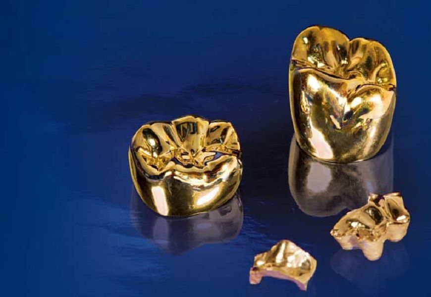 What gold is used for in dentistry. Dental crowns - what are they